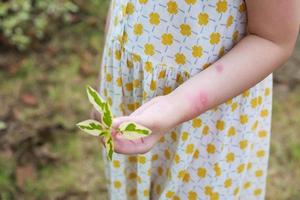 Little girl has skin rash allergy itching and scratching on her arm photo