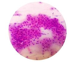 frotis de Papanicolaou tinción de Papanicolaou microscópica zoom 40x mostrar lesión intraepitelial escamosa de alto grado es una enfermedad precancerosa de transmisión sexual foto