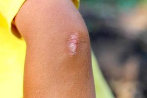 Scar on the elbow of the child. photo