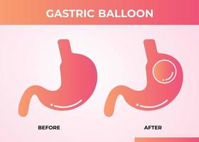 endoscopia estomacal balón gástrico dentro de un estómago cirugía de pérdida de peso ilustración vectorial obesidad