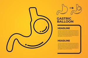 endoscopia estomacal balón gástrico dentro de un estómago cirugía de pérdida de peso ilustración vectorial obesidad vector