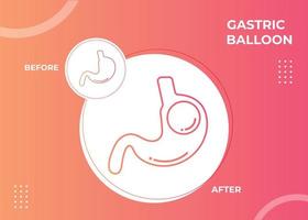 Stomach Endoscopy Gastric Balloon Inside a Stomach weight loss surgery vector illustration obesity