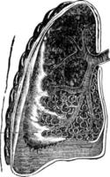 Lung with Pneumonia, vintage illustration vector