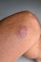 bruised on knee - wound bruised on  leg caused by sports and bump or fall, leg injury photo