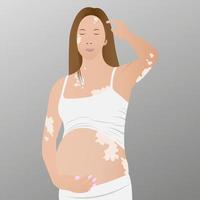 Young, pregnant woman with vitiligo on the skin. Beauty diversity concept, positive body, self-acceptance, awareness of chronic skin diseases, illustration vector