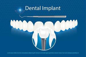 Vector 3d realistic white dental implant on blue background with beautiful teeth mockup. implant model with thread and inscription.