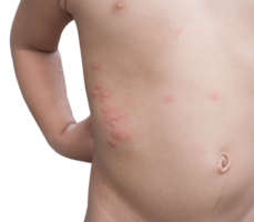 Boy with multiple and insect bites on body isolated png