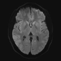 Realistic axial image of male cerebrum with CT scan, MRI Magnetic resonance imaging layer of brain. Isolated on dark background. Vector illustration.