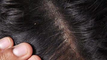 Dark hair roots, scalp video