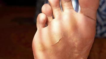 A foot sole with cracks video