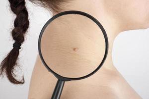 doctor examines papillomas on a patient through a magnifying glass lens photo