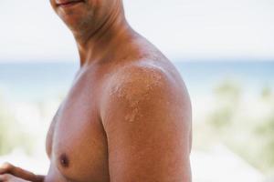 primer plano de un hombro rojo y la espalda de un hombre con la piel quemada por el sol foto