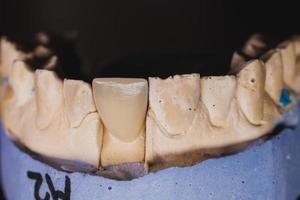 primer plano de una dentadura postiza de yeso con dientes de porcelana foto