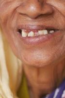 primer plano de la caries dental de mujeres mayores y algunos dientes rotos foto
