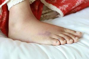 close up of women feet with swelling photo