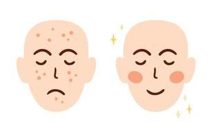 Acne face treatment concept with two different faces before and after. Acne skin problem. Acne scars. Anti acne cosmetic brand character elements isolated on white. Cartoon vector illustration.