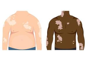 Fat and thin african american man with vitiligo patches on skin. Beauty diversity concept, body positive, chronic skin disease awareness, illustration vector