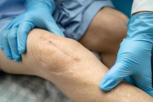 Asian senior or elderly old lady woman patient show her scars surgical total knee joint replacement Suture wound surgery arthroplasty on bed in nursing hospital ward, healthy strong medical concept. photo