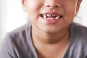 child girl smiling with deformed teeth photo