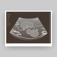 Ultrasound of a twin in the womb. Vector illustration in grayscale. An ultrasound image of a baby. Medicine and health of the fetus of twins. Realistic Embryo Sonogram