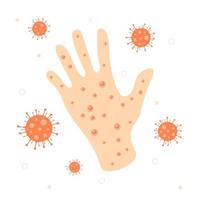 Acne on the hand from MonkeyPox vector