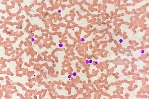 Photomicrograph of hematological slide showing monocytosis. Abnormal monocyte. photo