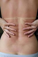 Back of Caucasian woman with red skin and bikini print after sunbathing on the beach. photo