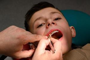 un ortodoncista pega y sujeta frenos en los dientes superiores de un colegial, alineando los dientes con frenos. foto