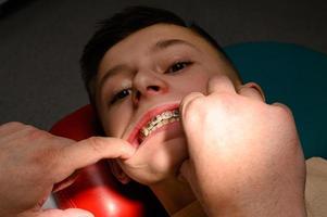 stretching rubber bands on braces. photo