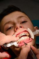 The teenager has braces glued to his upper teeth to straighten them, and the boy has a retractor on his lips. photo