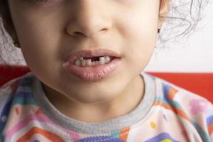 Retrato de niña de 6 años con lugar de diente de leche extraído foto