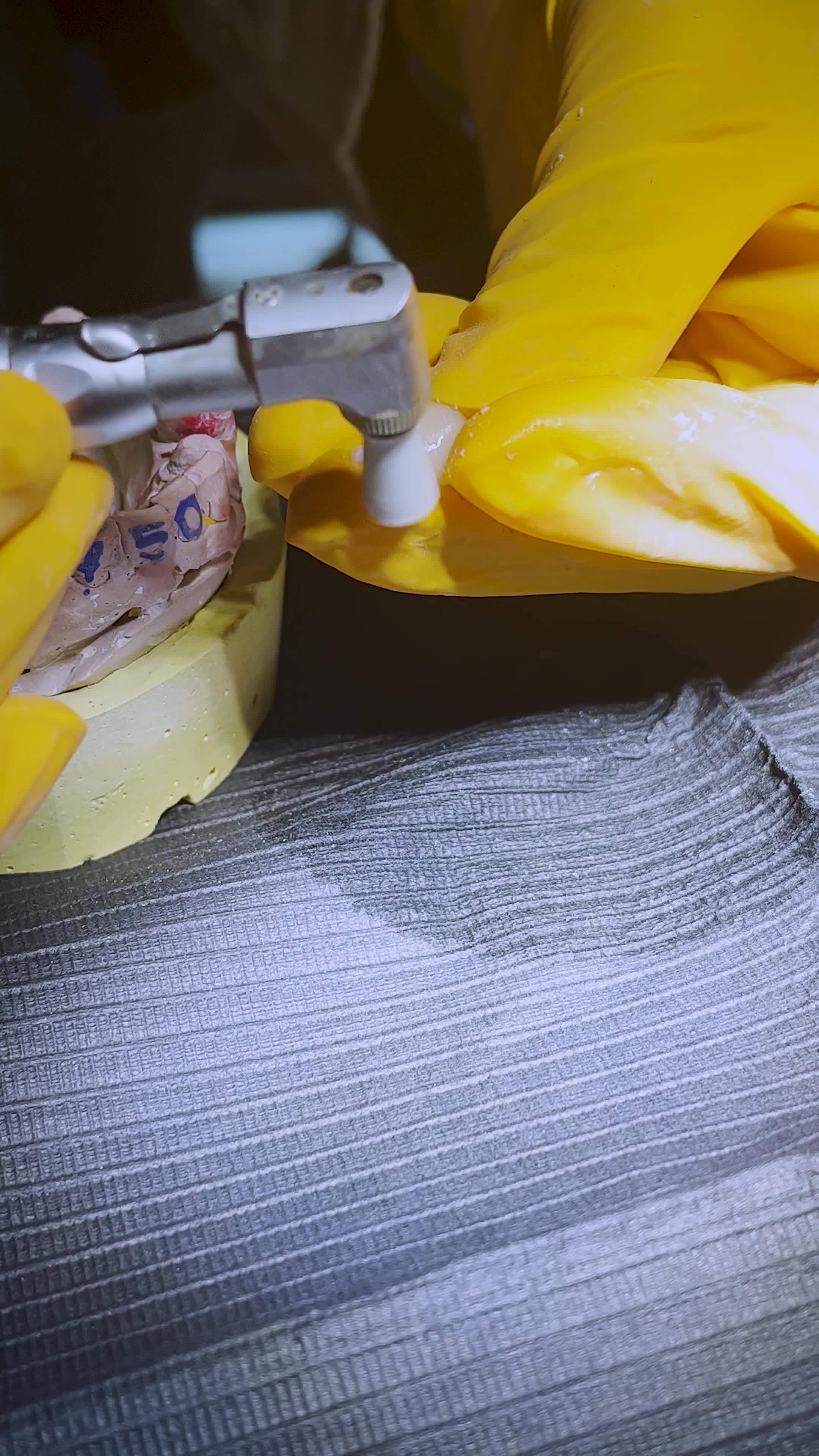 placing the fixed retainer in Process of removing dental braces from a