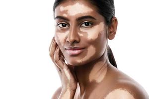 Beautiful South Asian woman with vitiligo skin disorder against white background photo