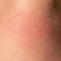 alergia en el cuerpo humano y enrojecimiento por una picadura de avispa. foto