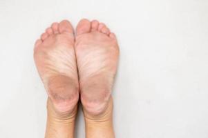 pies con piel seca para mostrar sobre el pie no saludable. debe ser a menudo el tratamiento en todos los días. foto