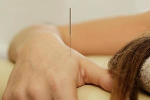 Female hand with steel needles during procedure of acupuncture therapy photo