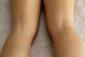 Female legs with steel needles during procedure of acupuncture therapy photo