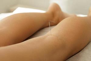 piernas femeninas con agujas de acero durante el procedimiento de terapia de acupuntura foto