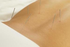 Female back with steel needles during procedure of acupuncture therapy photo