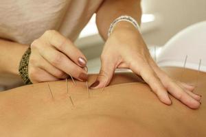 Master is injecting steel needles during procedure of acupuncture therapy photo