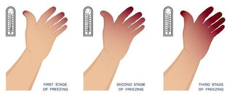 hand of man with different stages of frostbite. Freezing and skin damage in winter in cold air. First aid for hypothermia. Vector