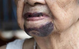Close up chin senior woman has bruises photo
