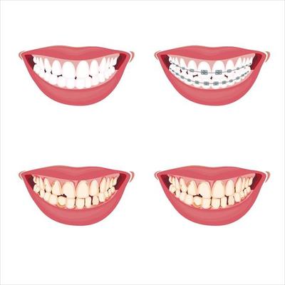 Healthy and Damaged tooth Illustration, Tooth Braces, Damaged Teeth, Dentist Vector Illustration, Oral Care