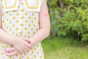 la niña tiene alergia a la erupción cutánea, picazón y rascado en el brazo