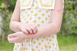 Little girl has skin rash allergy itching and scratching on her arm photo