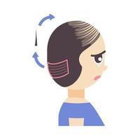 FUE hair transplant treatment of alopecia. Side view of a woman. Female hair loss pattern. Medical infographics. Cartoon vector illustration.