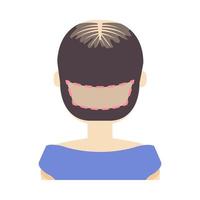 FUE hair transplant treatment of alopecia. Back view of a woman at surgery. Female hair loss pattern. Medical infographics. Cartoon vector illustration.