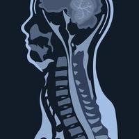 magnetic resonance image or MRI of the cervical spine in sagittal projection demonstrating cervical spondylosis and spinal cord compression. The disease causes neck pain and radiculopathy. vector