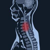 MRI of the cervical spine with and without contrast, MRI with bilateral C7 root compression, Cervical spondylosis vector