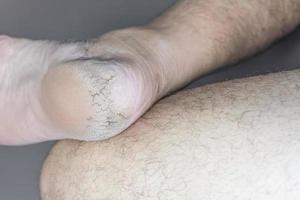 Close up cracked heel further deep cracks and dry flaky skin photo